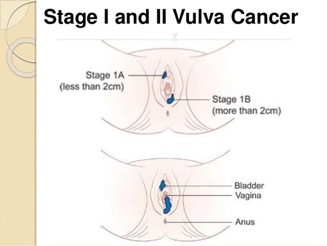 a lump on the vagina A lump on the vagina